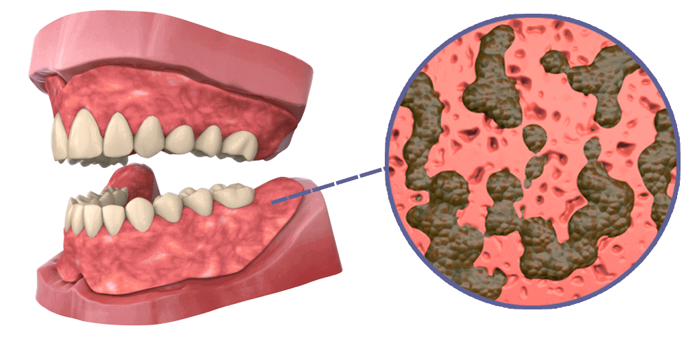 Microporosity Denture